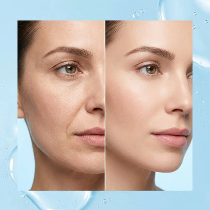 💎Erase 30–40% of Your Nasolabial “Tired Lines” While You Sleep—Without a Single Needle, Toxin, or Risk of Pillow Face✨