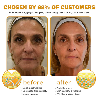 💥BUY 1 GET 1 FREE💥Botox Bee Venom Wrinkle Removal Cream