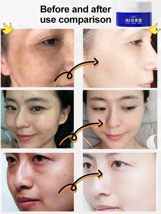 🔥Buy 1 Get 1 Free🔥Spot Fading Urea Cream