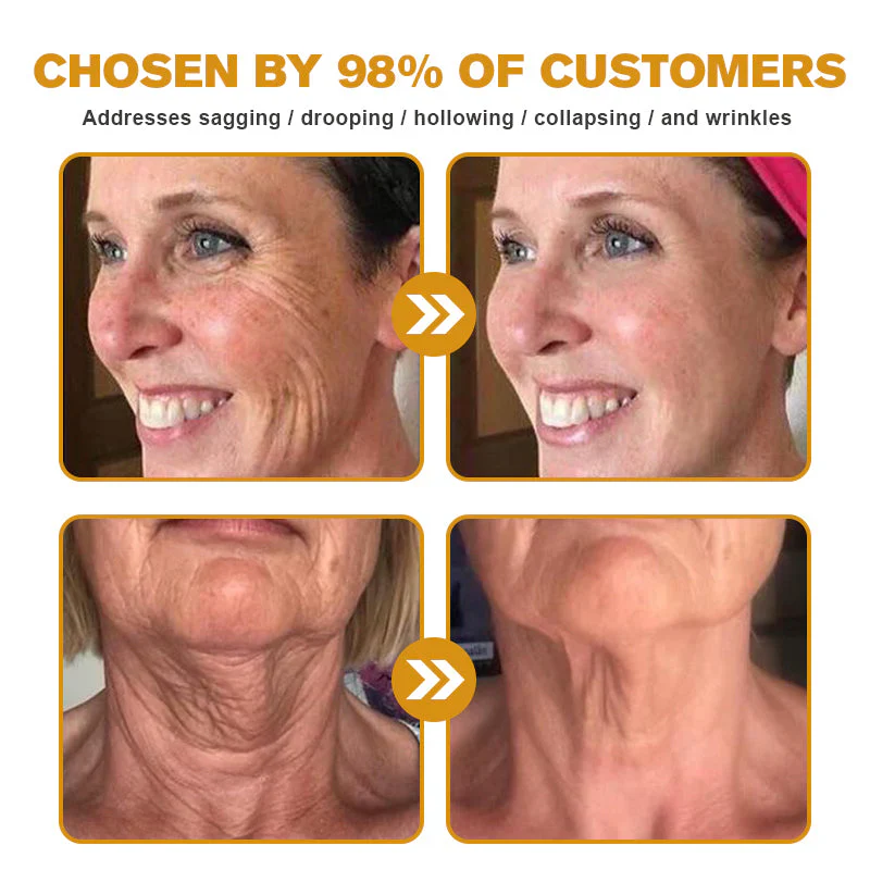 💥BUY 1 GET 1 FREE💥Botox Bee Venom Wrinkle Removal Cream