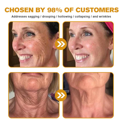 💥BUY 1 GET 1 FREE💥Botox Bee Venom Wrinkle Removal Cream