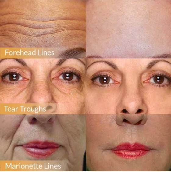 🔥 Buy 1 Get 1 Free🔥POLYPEPTIDE FIRMING FULL FACE CREAM-CHANGE FOR BEAUTIFUL SKIN WITHIN 2 WEEKS